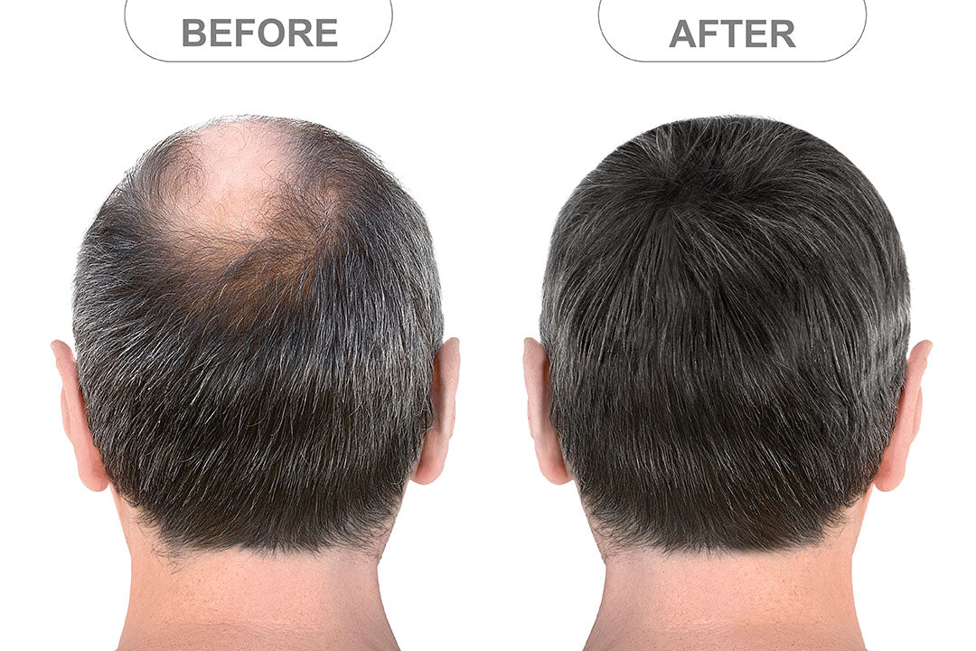 Hair Growth Therapy Cap – Red Light Treatment – SmartNetwork