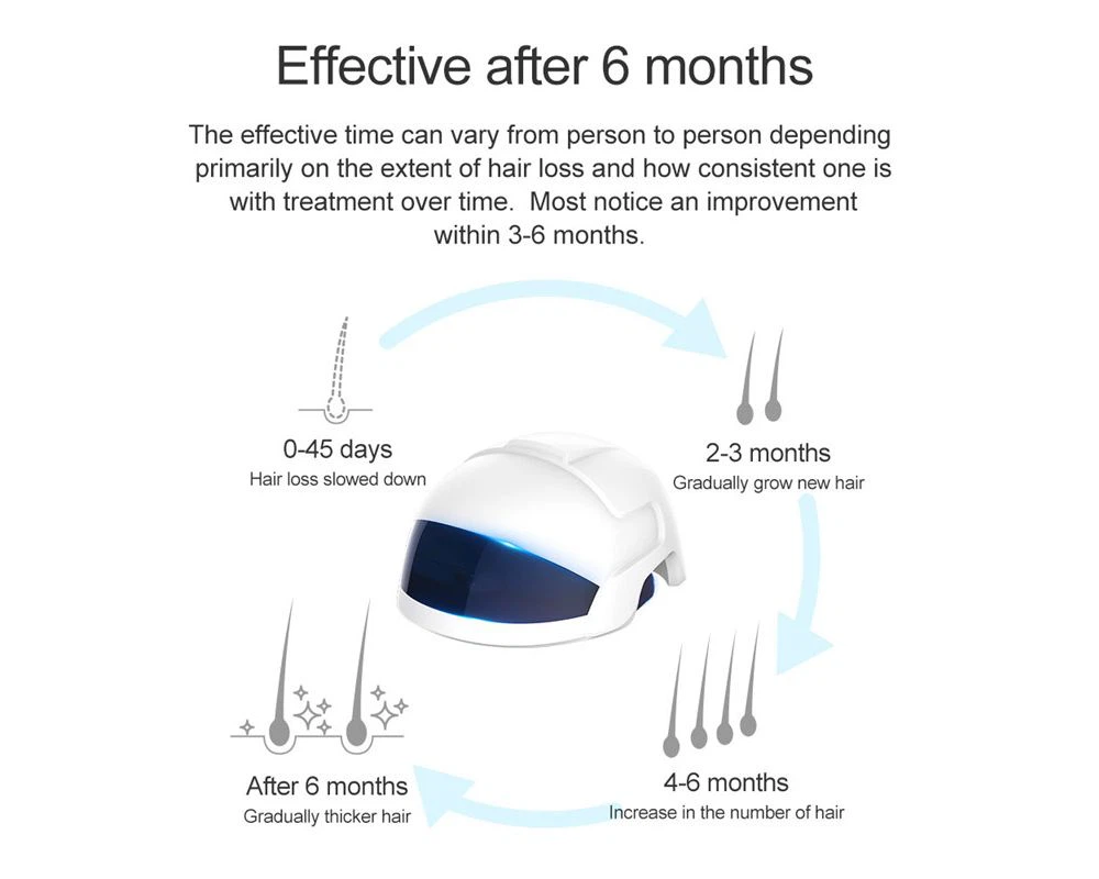 Hair Growth Helmet – Laser Hair Treatment – SmartNetwork
